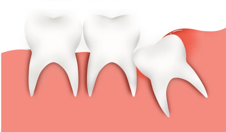 Wisdom Teeth: Everything You Need to Know