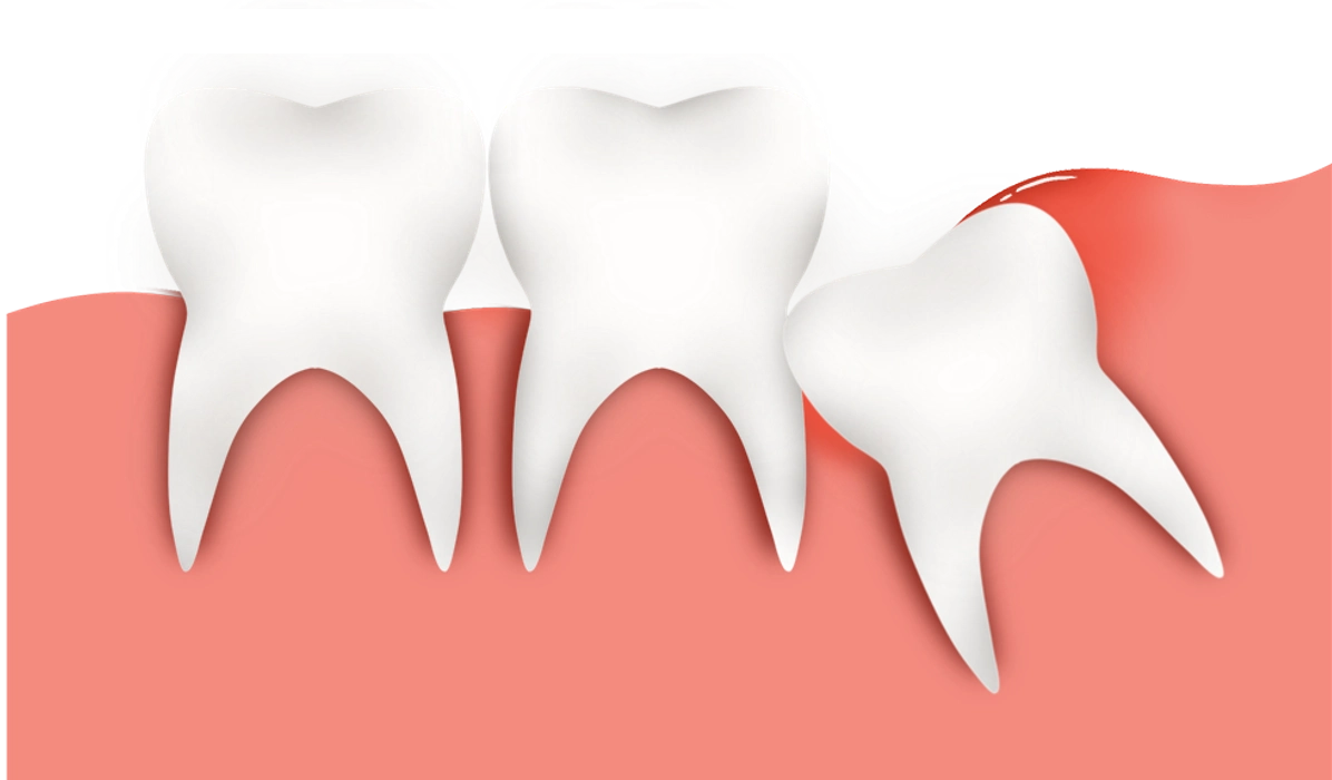 wisdom teeth