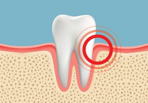 chảy máu nướu răng