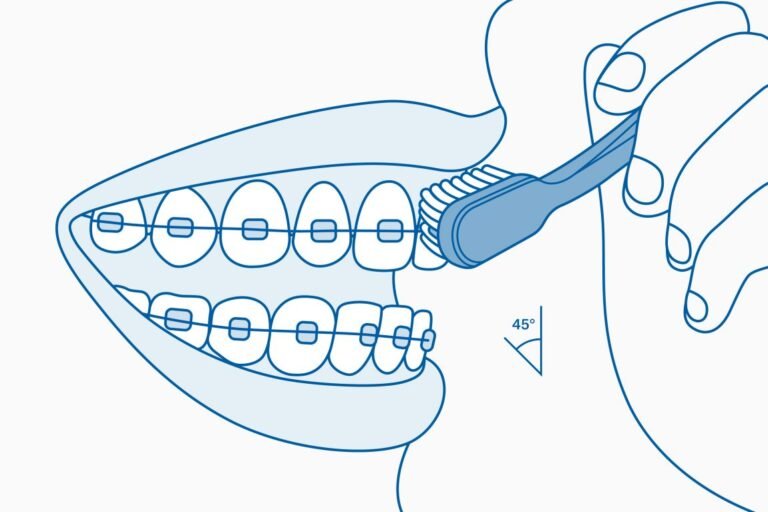 Phương pháp đánh răng Bass cải tiến